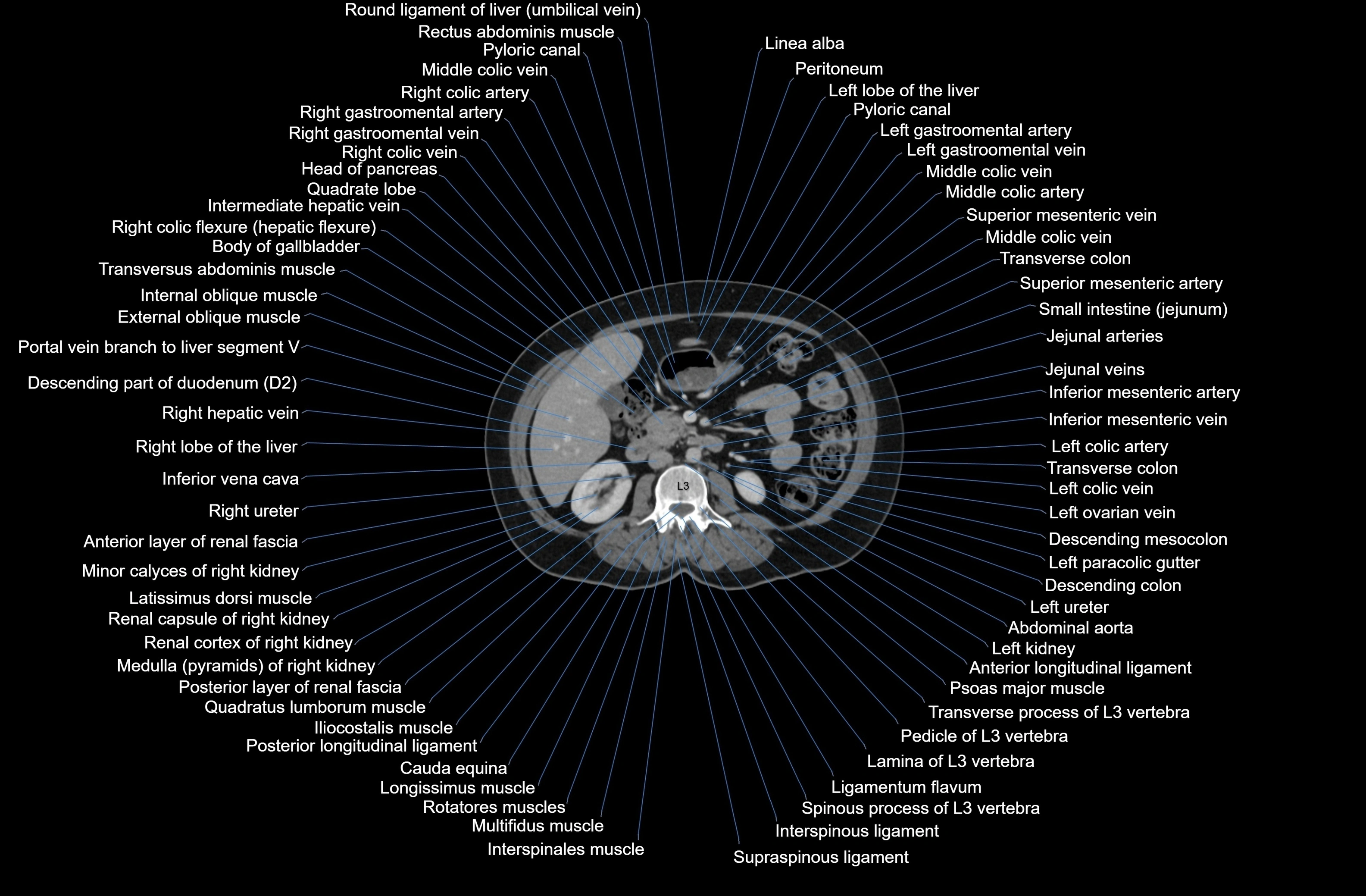 CT Abdomen axial cross sectional anatomy labelled radiology image-00041.webp